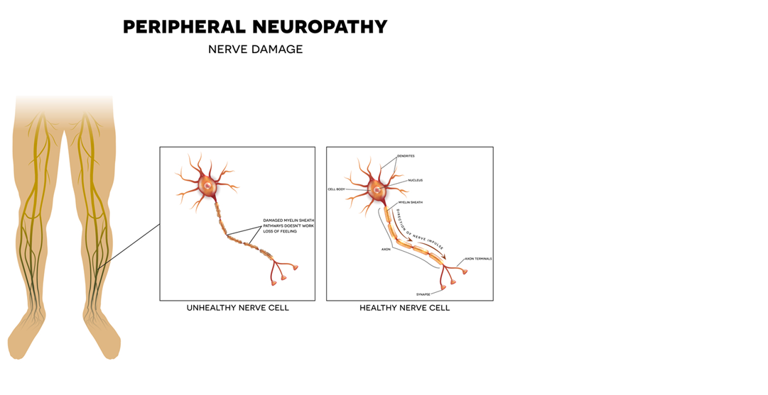 neuropathy-3