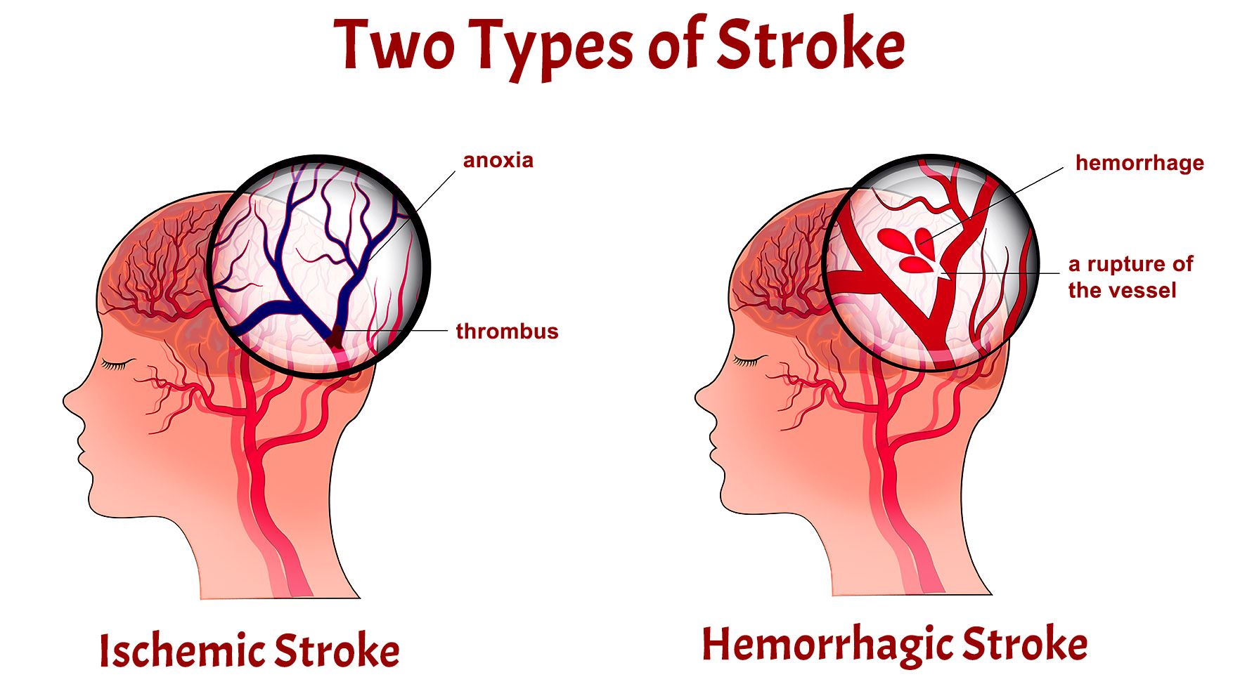 stroke-3