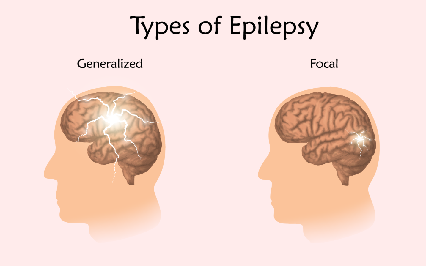 epilepsy